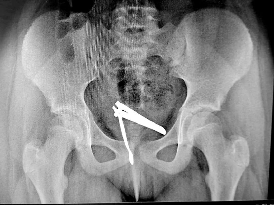 В Липецке у ребенка извлекли кусачки из интимного места