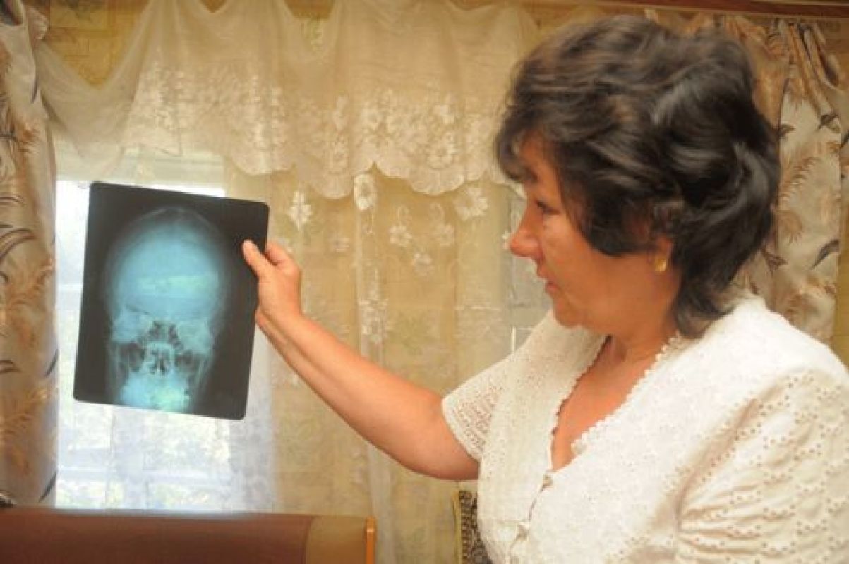 Брат осуждённого Алексея после полученных травм головы стал эпилептиком